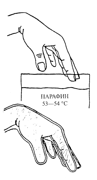 Парафиновая перчатка